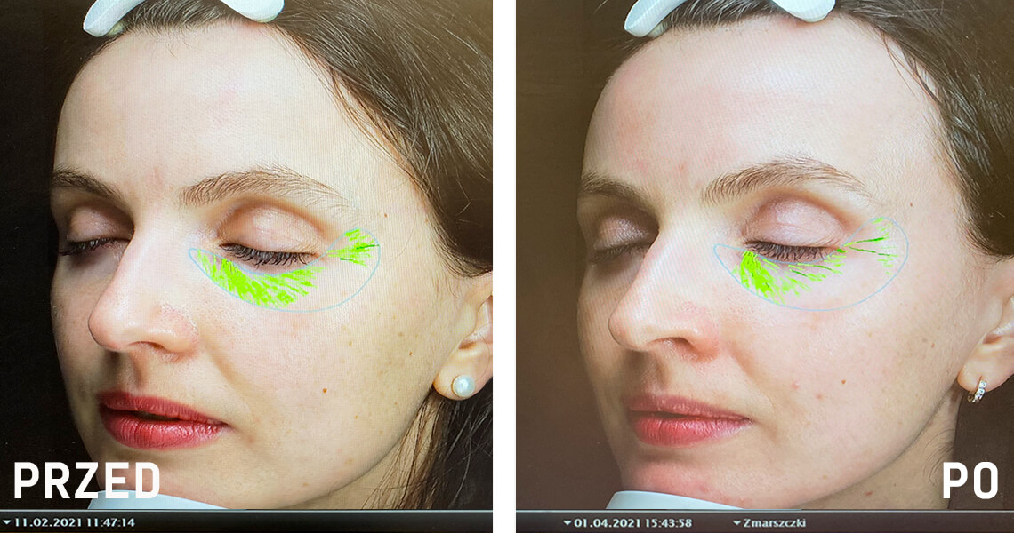 Zdjęcie z komputerowego raportu analizy skóry - przed i po 7 tygodniach stosowania The Solution™